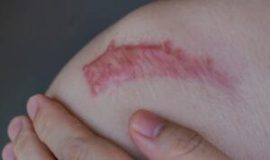 Spesialis Kulit RSUD Bontang Sebut Operasi Keloid Harus Dipertimbangkan Matang, Risiko Luka Baru Mengintai