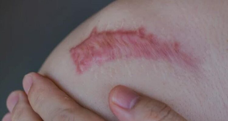 Spesialis Kulit RSUD Bontang Sebut Operasi Keloid Harus Dipertimbangkan Matang, Risiko Luka Baru Mengintai