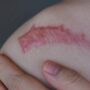 Spesialis Kulit RSUD Bontang Sebut Operasi Keloid Harus Dipertimbangkan Matang, Risiko Luka Baru Mengintai