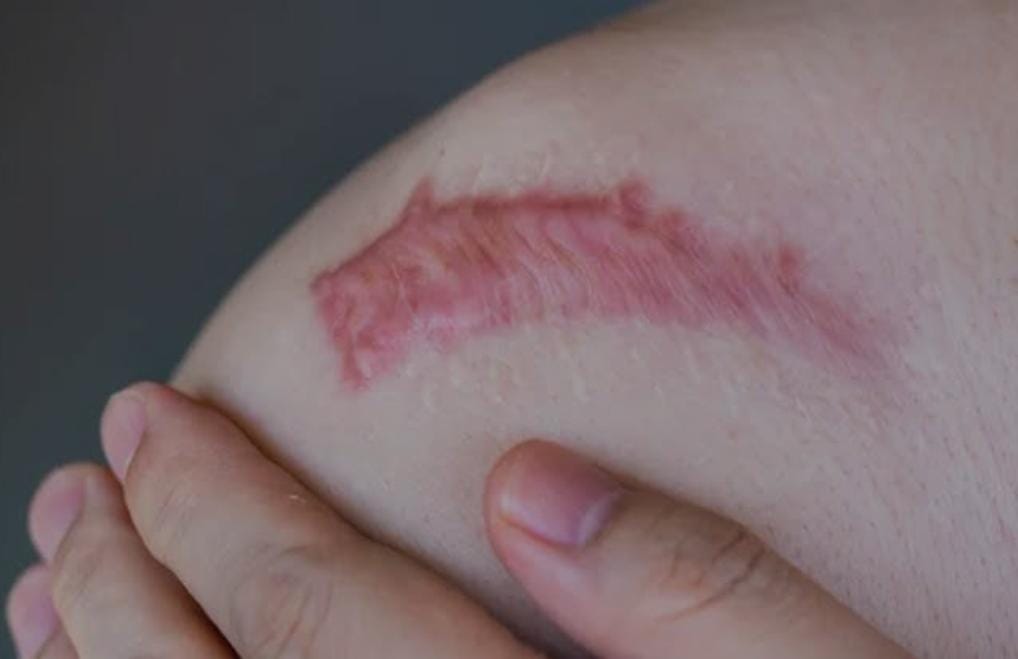 Spesialis Kulit RSUD Bontang Sebut Operasi Keloid Harus Dipertimbangkan Matang, Risiko Luka Baru Mengintai